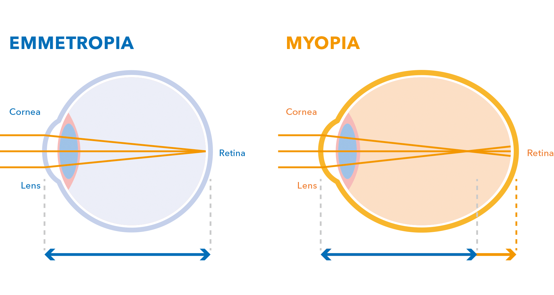 MIOPÍA1 MIOPÍA1